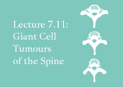7.11 Giant Cell Tumours of the Spine