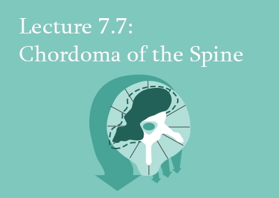 7.7 Chordoma of the Spine