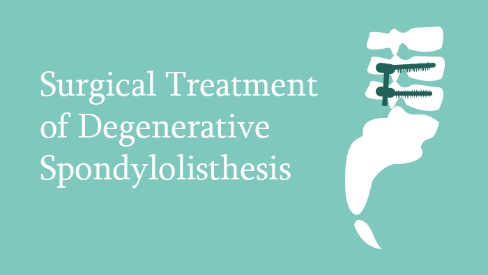 Surgical Treatment of Degenerative Spondylolisthesis Lecture Thumbnail