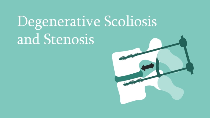 Degenerative Scoliosis and Stenosis Lecture Thumbnail