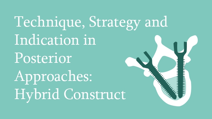 Technique, Strategy and Indication in Posterior Approaches: Hybrid Construct Lecture Thumbnail