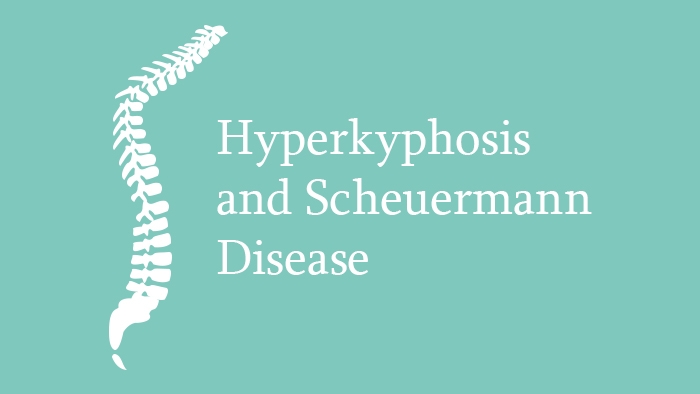 Hyperkyphosis and Scheuermann Disease Lecture Thumbnail