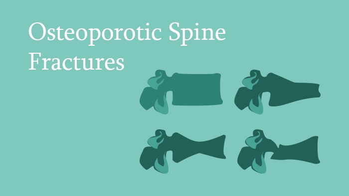 Osteoporotic Spine Fractures - Spine Surgery Lecture - Thumbnail