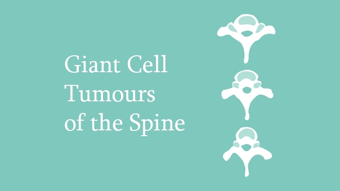 Giant Cell Tumours of the Spine Lecture Thumbnail