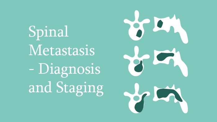 Spinal Metastasis – Diagnosis and Staging Lecture Thumbnail
