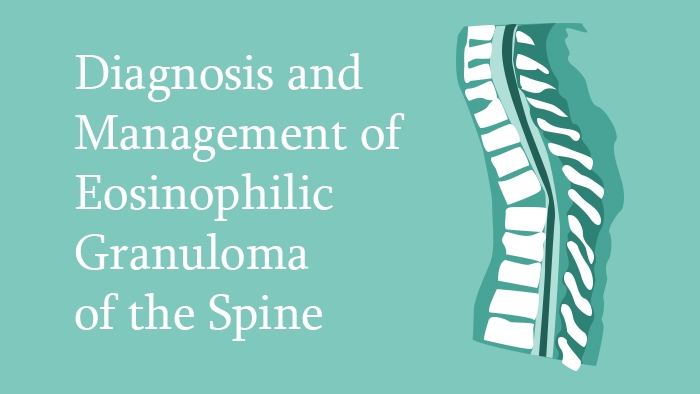 Stabilising and Corrective Surgery of the Thoracolumbar Spine in Ankylosing Spondylitis Lecture Thumbnail