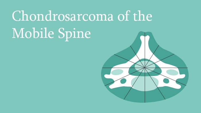 Chondrosarcoma of the Mobile Spine Lecture Thumbnail