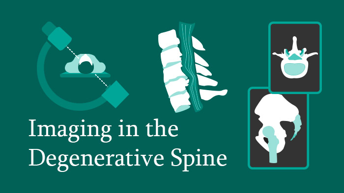 Spine Radiology: Imaging in the Degenerative Spine Thumbnail