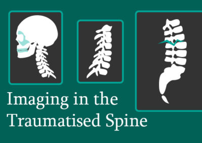 Imaging in the Traumatised Spine