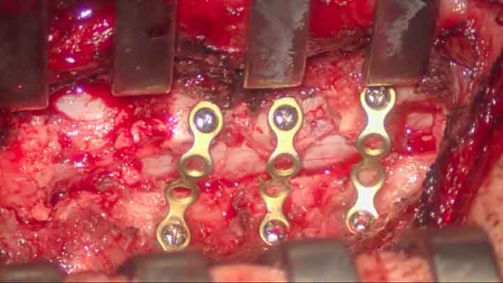 Image from a Spine Surgery Film